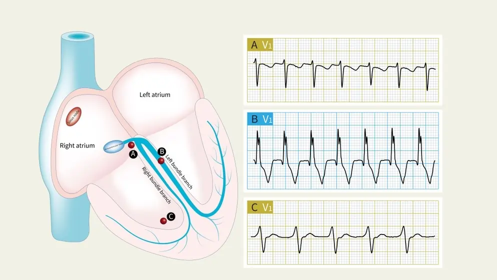 Ventricular Tachycardia Causes Symptoms And More Stayhale