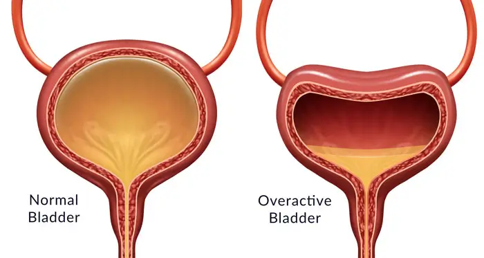 normal and overactive-bladder